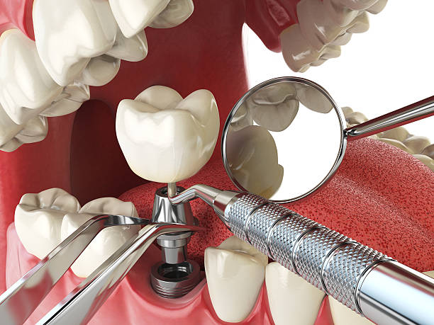 Best Broken Tooth Emergency  in Mayflower Village, CA